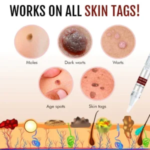 Tags & Moles Remover - Image 4