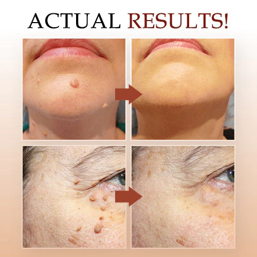 Tags & Moles Remover - Image 3