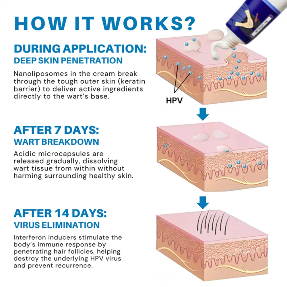 Warts Relief Cream - Image 5