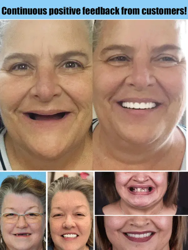 🦷Advanced Customized Full Denture Set🦷 - Image 7