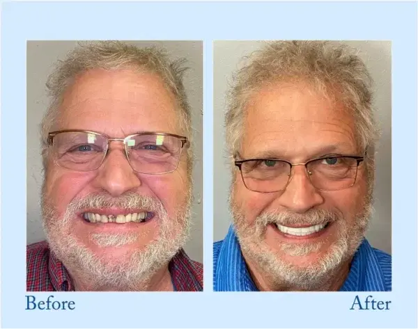 🦷Advanced Customized Full Denture Set🦷 (⏰Limited time discount last 30 minutes⏰)🍁🍁 - Image 5