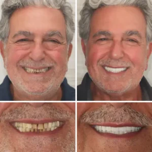🦷Advanced Customized Full Denture Set🦷 (⏰Limited time discount last 30 minutes⏰) - Image 5