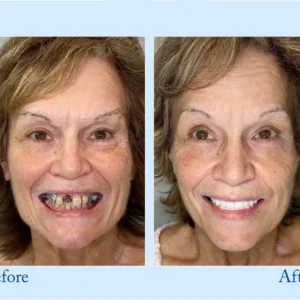 Premium Dentures - Image 4