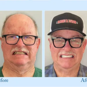 Premium Dentures - Image 8