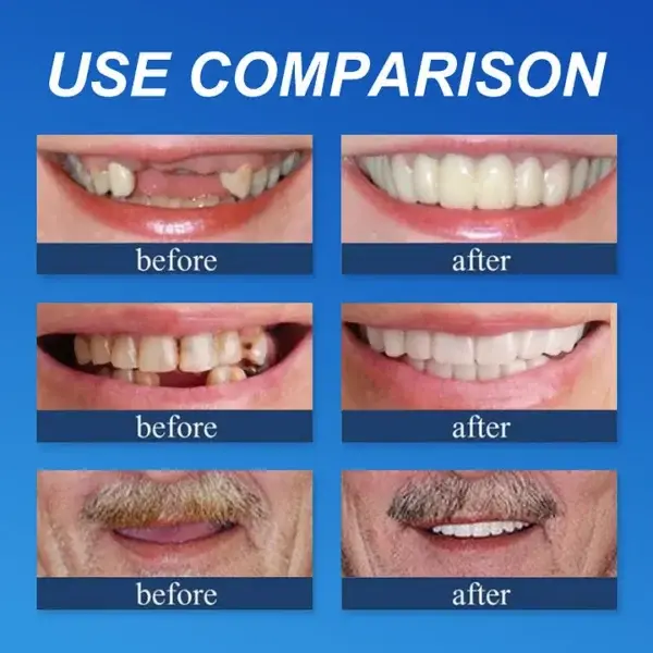 Advanced Customized Full Denture Set🦷 - Image 4