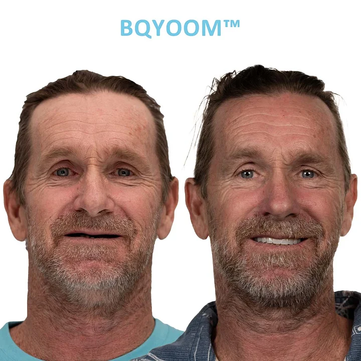 GelFit Dentures - Image 4