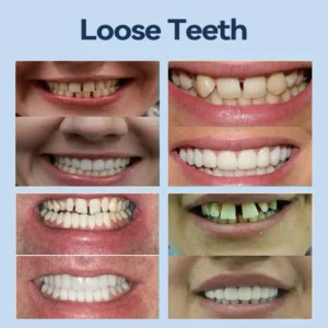 👧🏻🔆- 𝐏𝐫𝐞𝐦𝐢𝐮𝐦 𝐃𝐞𝐧𝐭𝐮𝐫𝐞- (✨Suitable for all mouth shapes, custom-made dentures for a perfect fit✨) - Image 6