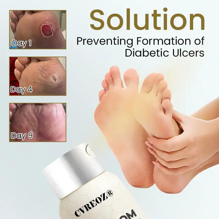 Bee Venom Diabetic Foot Healing Spray - Image 7