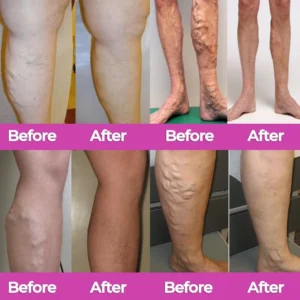 Advanced Varicose Vein Patch - Image 9