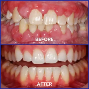 Bee Venom Dental Therapy Oral Power - Image 2