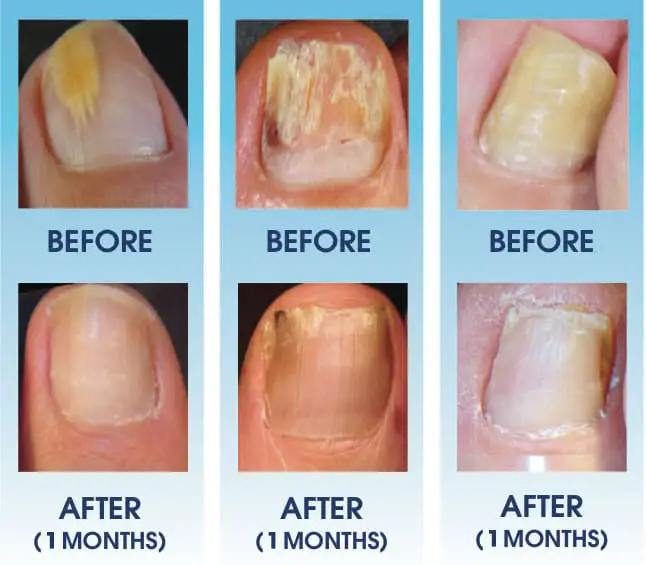 Nail Fungus Laser Treatment Device - Image 11