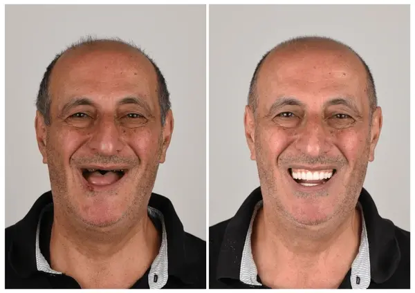 🦷 Custom-Fit Functional Dentures 😁 Smile with Confidence - Image 2