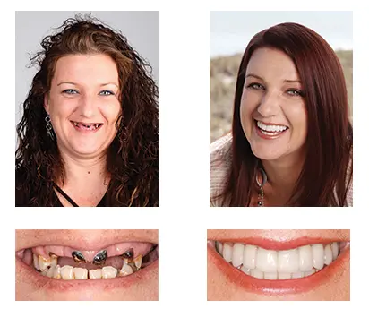 🦷 Custom-Fit Functional Dentures 😁 Smile with Confidence - Image 5