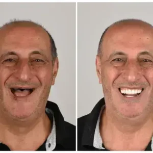 Alternative view of 🦷 Custom-Fit Functional Dentures 😁 Smile with Confidence