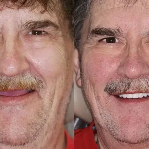 🦷Advanced Customized Full Denture Set🦷 - Image 8
