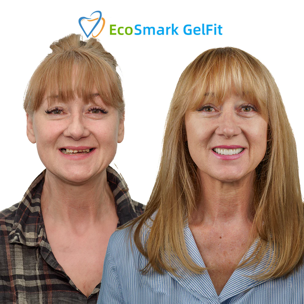GelFit Dentures - Image 7