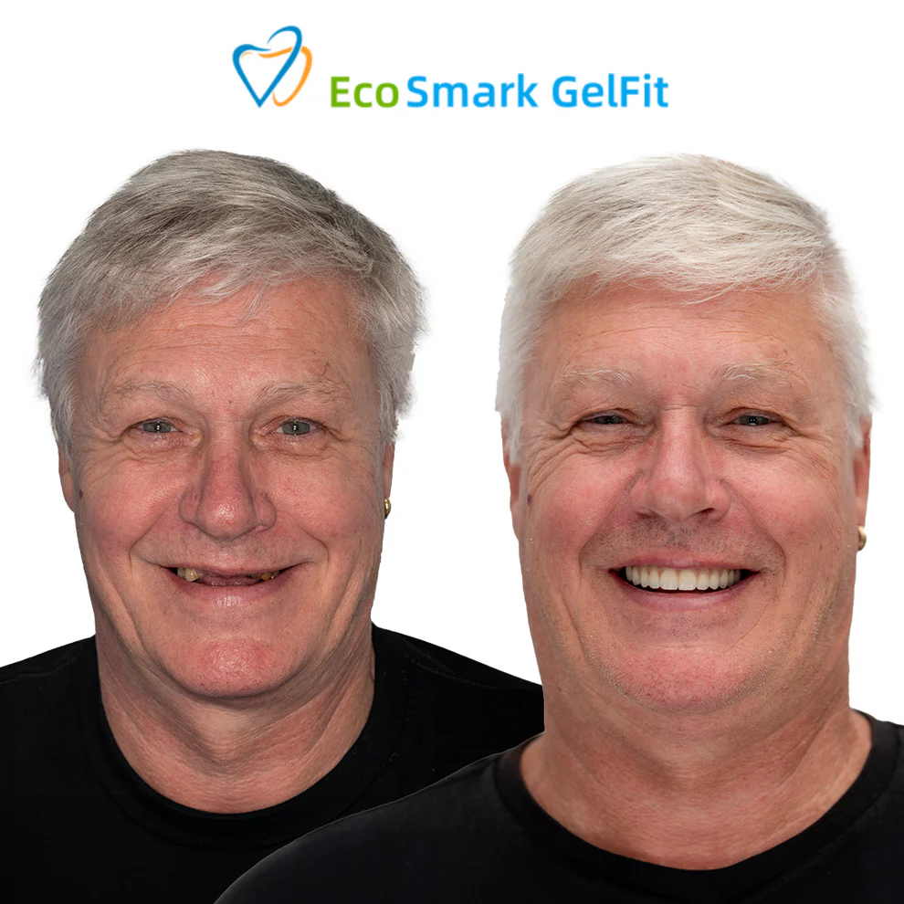 GelFit Dentures - Image 5