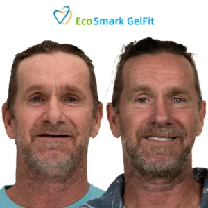GelFit Dentures - Image 8