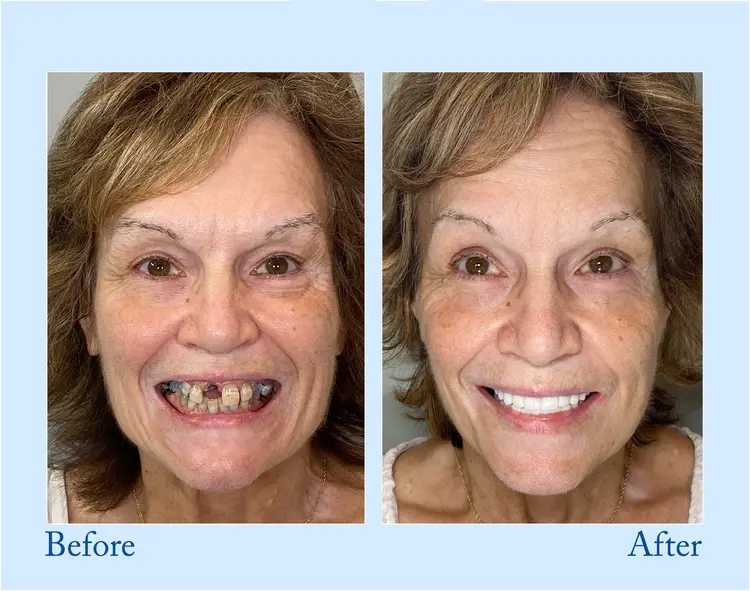 Premium Customized Full Denture Set🦷 - Image 2