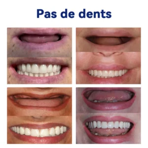Prothèse Dentaire Complète Sur Mesure Haut de Gamme - Image 8