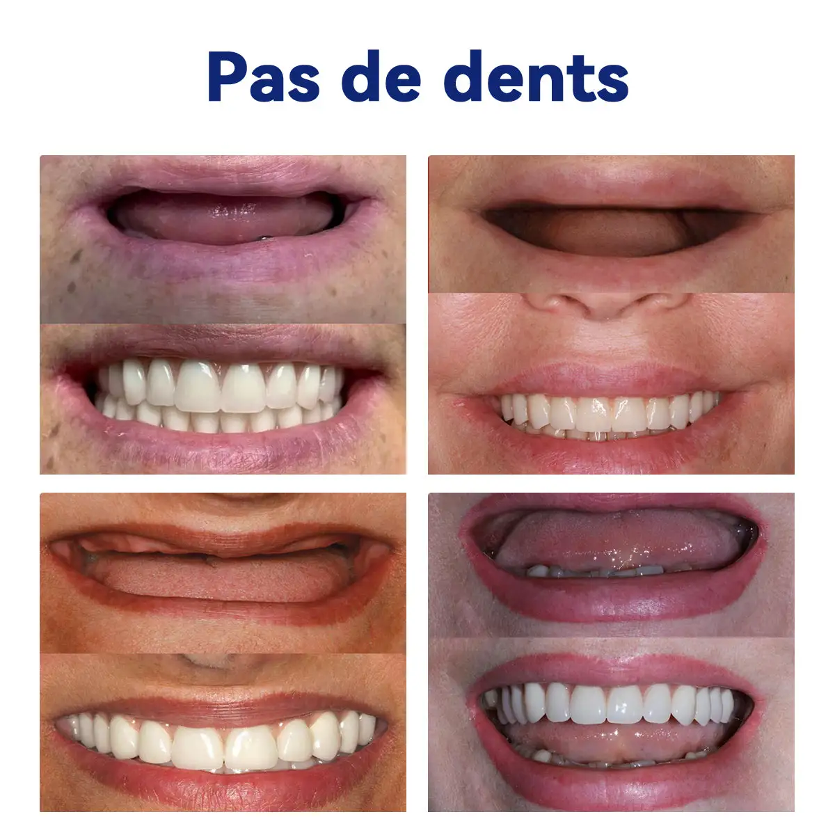 Prothèse Dentaire Complète Sur Mesure Haut de Gamme - Image 8