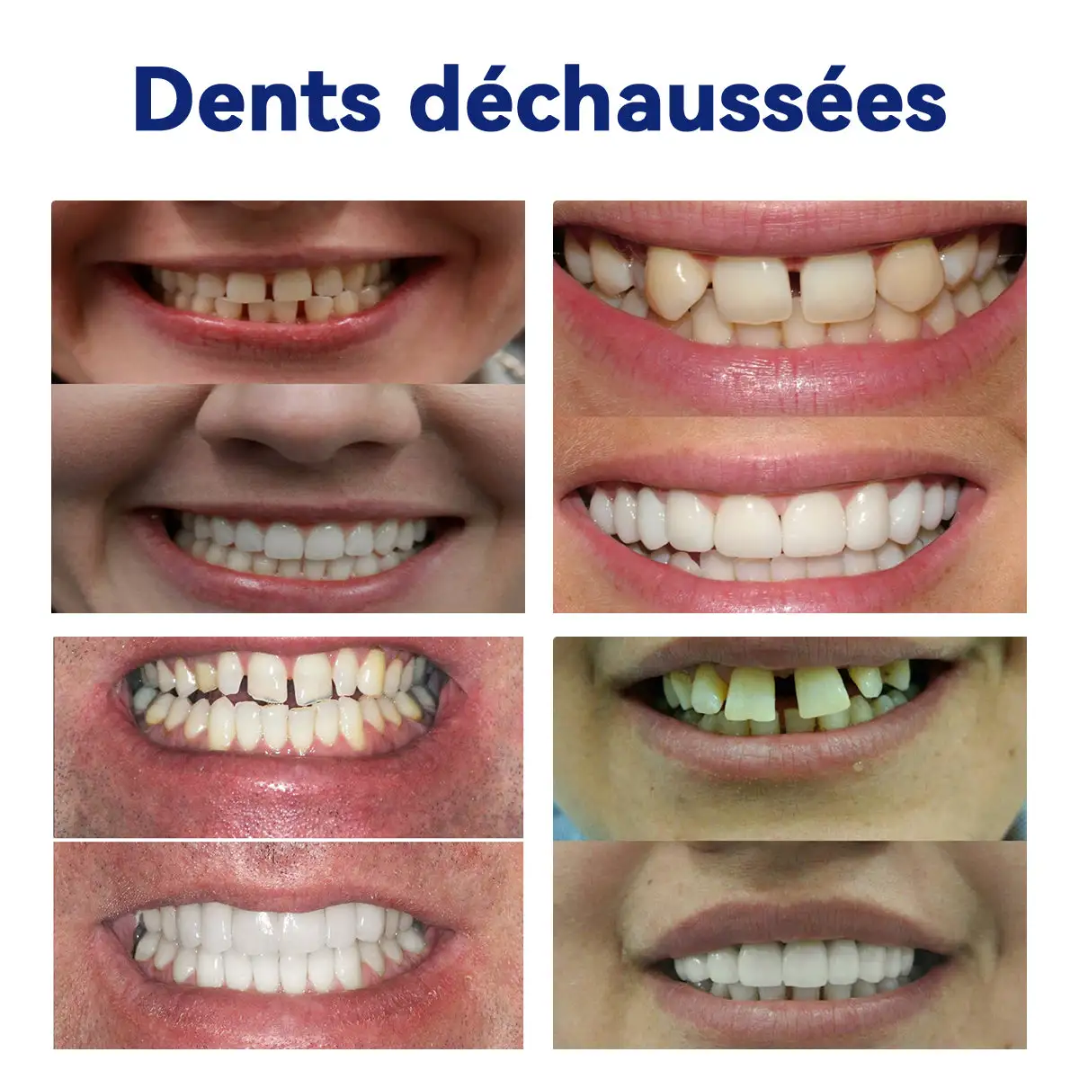Prothèse Dentaire Complète Sur Mesure Haut de Gamme - Image 7