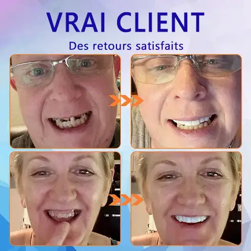 Prothèse Dentaire Complète Sur Mesure Haut de Gamme - Image 9