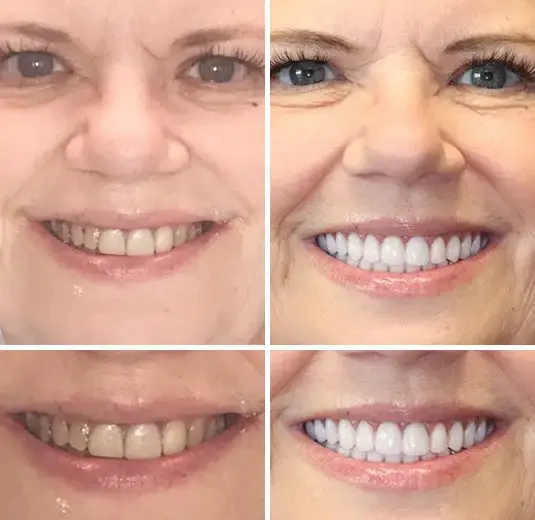 Set di protesi dentarie complete personalizzate avanzate🦷 - Image 9