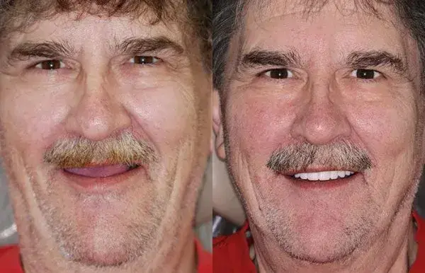 🦷Advanced Customized Full Denture Set - Image 10