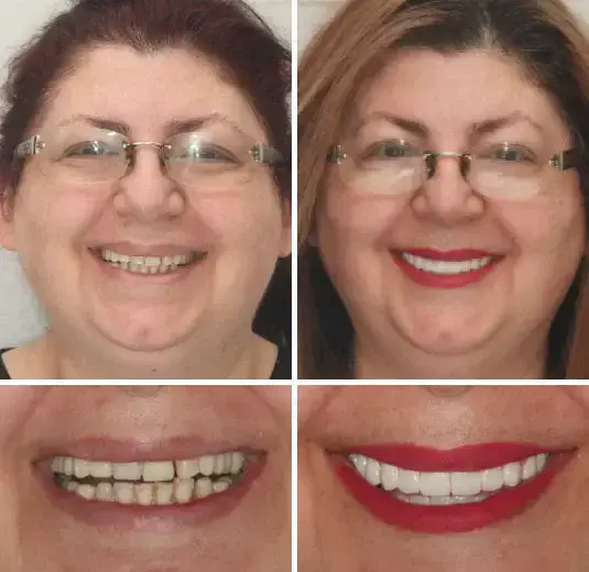🦷Advanced Customized Full Denture Set - Image 7