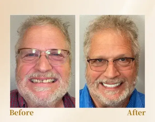 🦷Advanced Customized Full Denture Set🦷 (⏰Limited time discount last 30 minutes⏰)🚁🚁 - Image 11