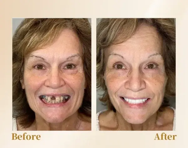 🦷Advanced Customized Full Denture Set🦷 (⏰Limited time discount last 30 minutes⏰)🚁🚁 - Image 6
