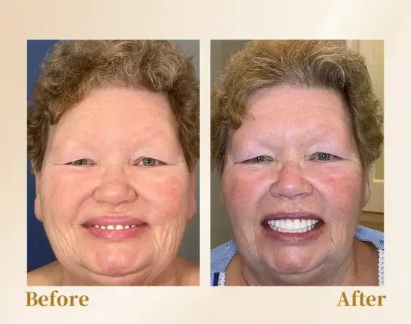 🦷Advanced Customized Full Denture Set🦷 (⏰Limited time discount last 30 minutes⏰)🚁🚁 - Image 7