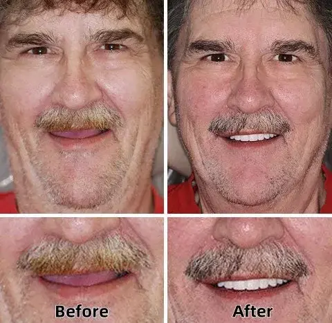 Advanced Custom-Fit Functional Dentures - Image 2