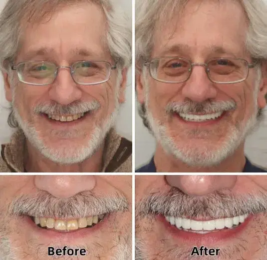 Advanced Custom-Fit Functional Dentures - Image 3
