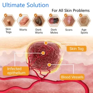 Non-Invasive Mole and Wart Removal Laser Pen - Image 9