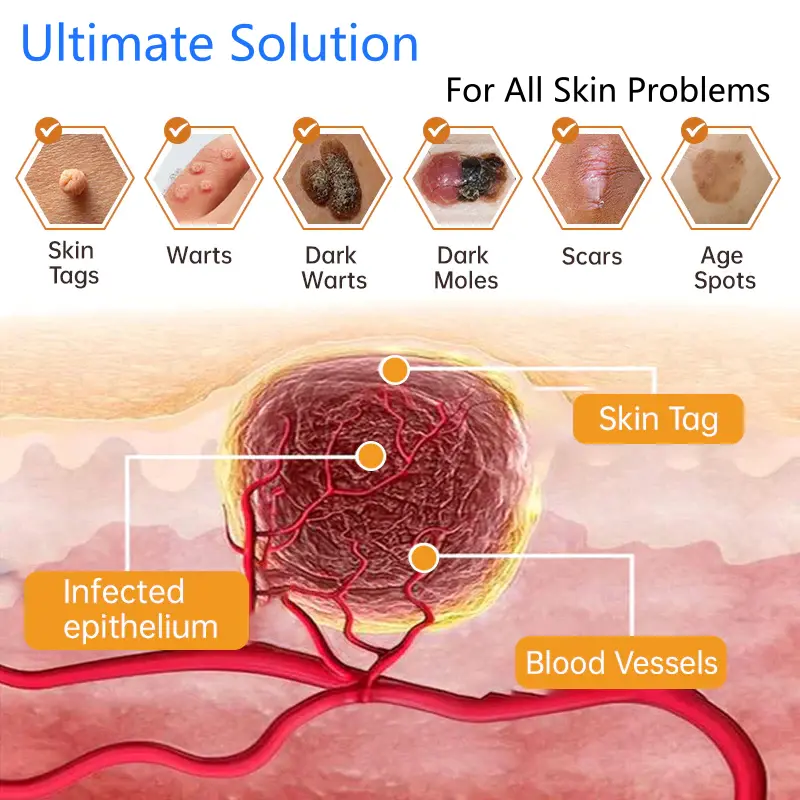 Non-Invasive Mole and Wart Removal Laser Pen - Image 9