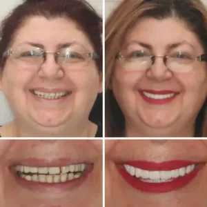 🦷Advanced Customized Full Denture Set🦷 - Image 9