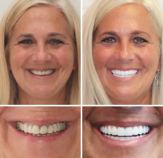 🦷Advanced Customized Full Denture Set🦷 - Image 7