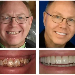 🦷 Custom-Fit Functional Dentures 😁 Smile with Confidence - Image 4