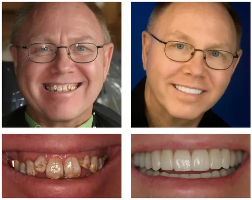 🦷 Custom-Fit Functional Dentures 😁 Smile with Confidence - Image 4