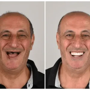 🦷 Custom-Fit Functional Dentures 😁 Smile with Confidence - Image 5