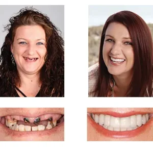 🦷 Custom-Fit Functional Dentures 😁 Smile with Confidence - Image 8