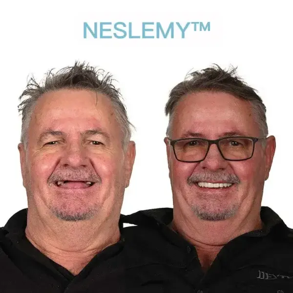 GelFit Dentures - Image 6