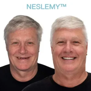 GelFit Dentures - Image 4