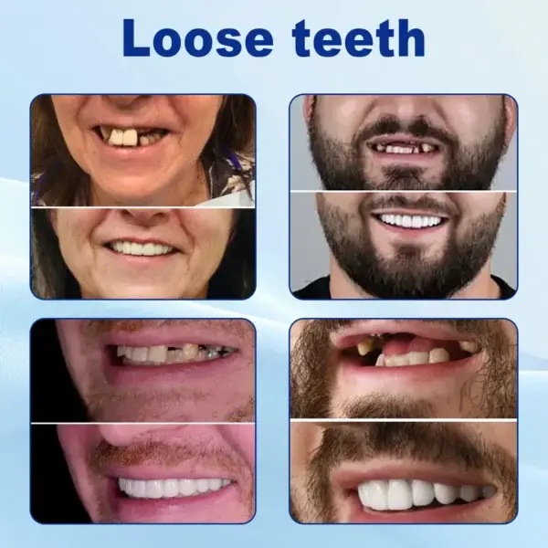 Advanced Customized Full Denture Set - Image 5