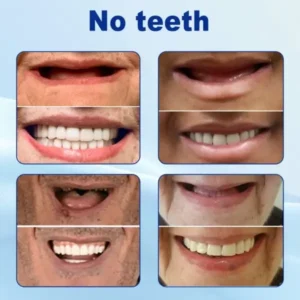 Advanced Customized Full Denture Set - Image 6