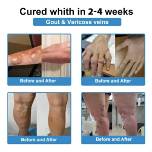 ✅ Official Store: Nano-Microneedle Joint Patch - Image 6