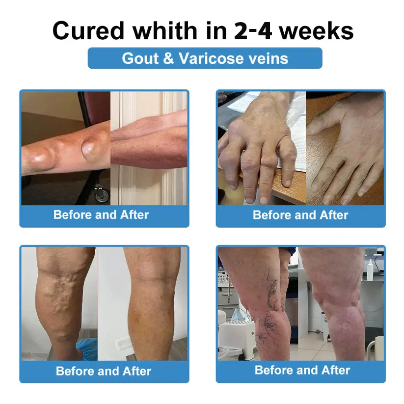 ✅ Official Store: Nano-Microneedle Joint Patch - Image 6