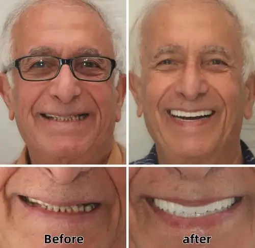Custom Functional Denture Kits - Image 4